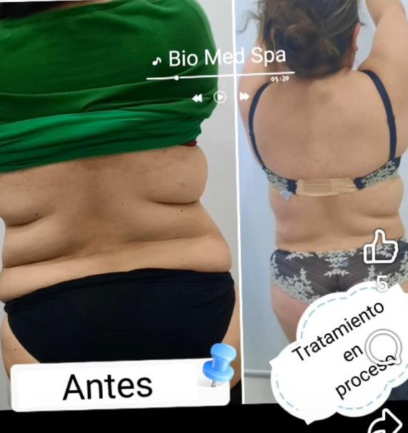 Reducción de Medidas — Abdomen