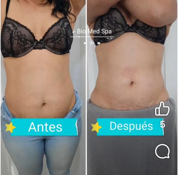 Reducción de Medidas — Abdomen Frontal