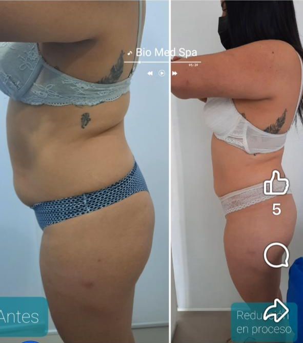 Reducción de Medidas — Perfil